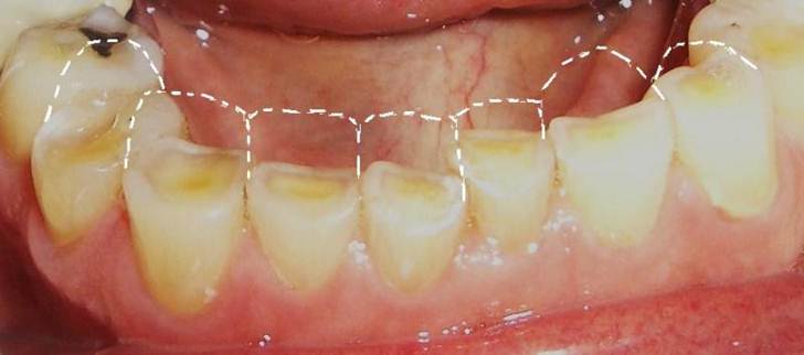 All You Need to Know About Dental Erosion